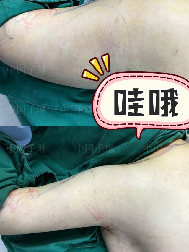 威塑抽脂,术后即刻效果#威塑吸脂