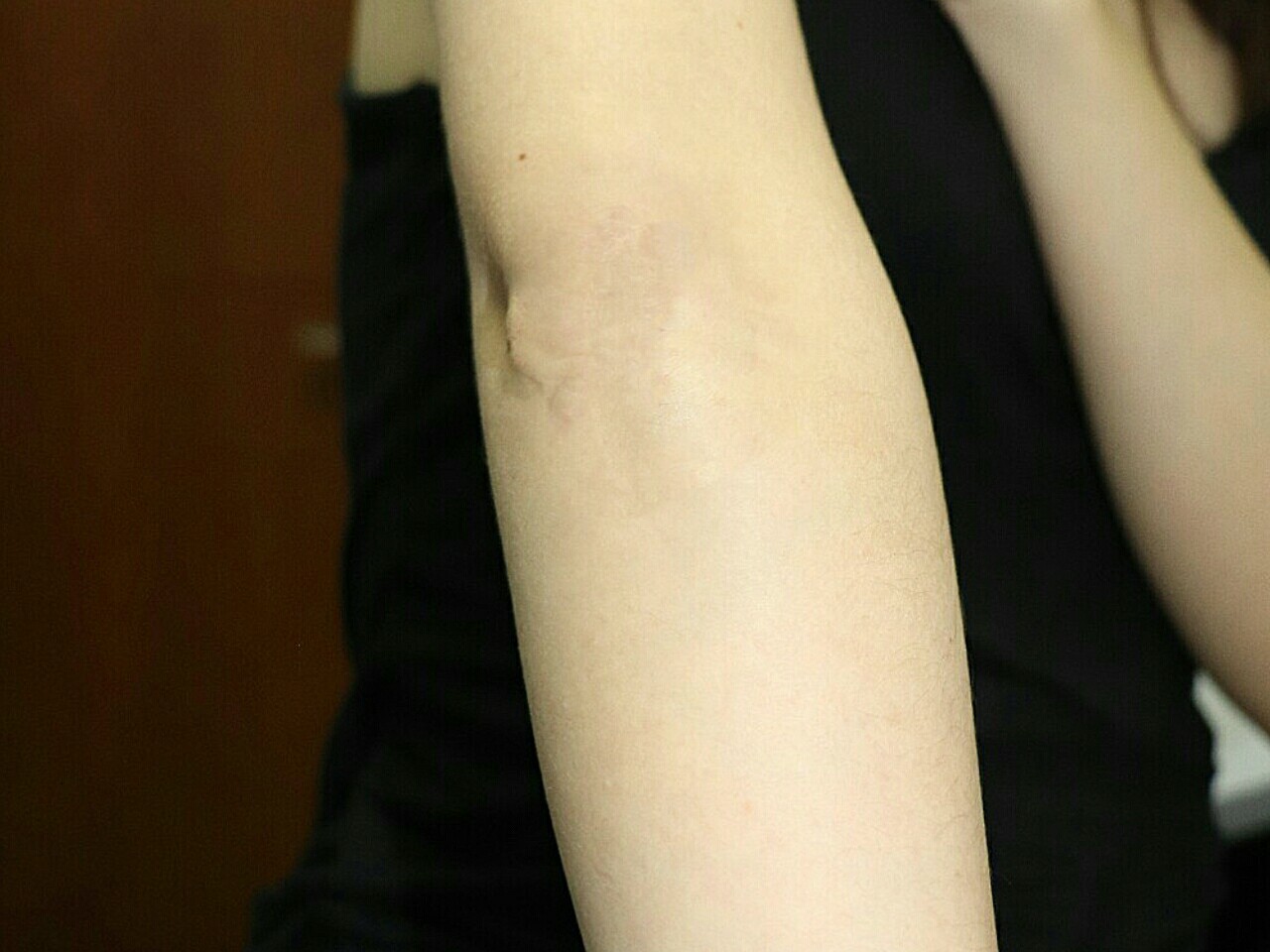 我胳膊上的疤痕有将近10年的历史了,市面上的祛疤产_圈子-新氧美容