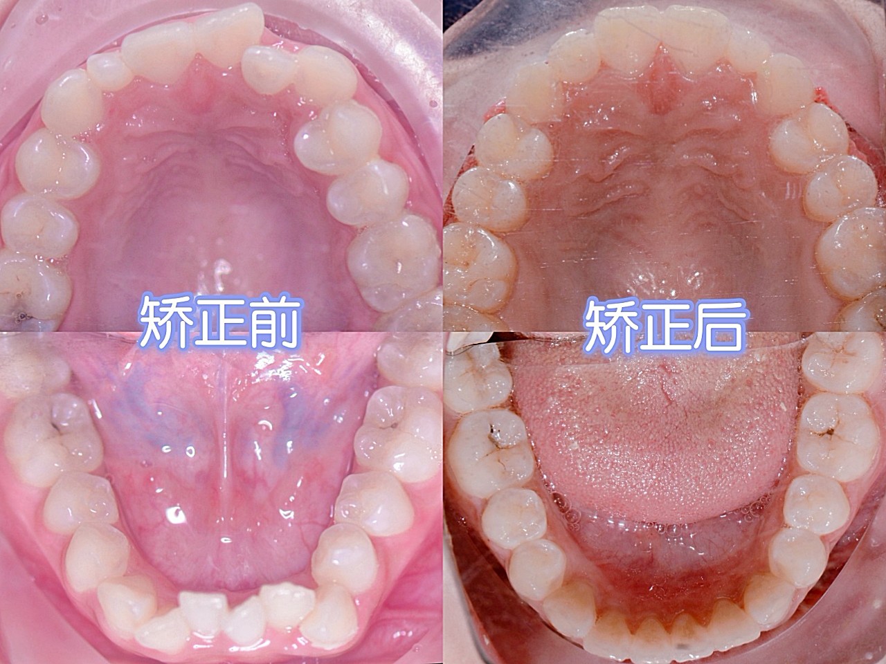 上下颌牙列拥挤,不齐,个别牙反合,右上2号过小牙,上下牙弓狭窄,磨牙