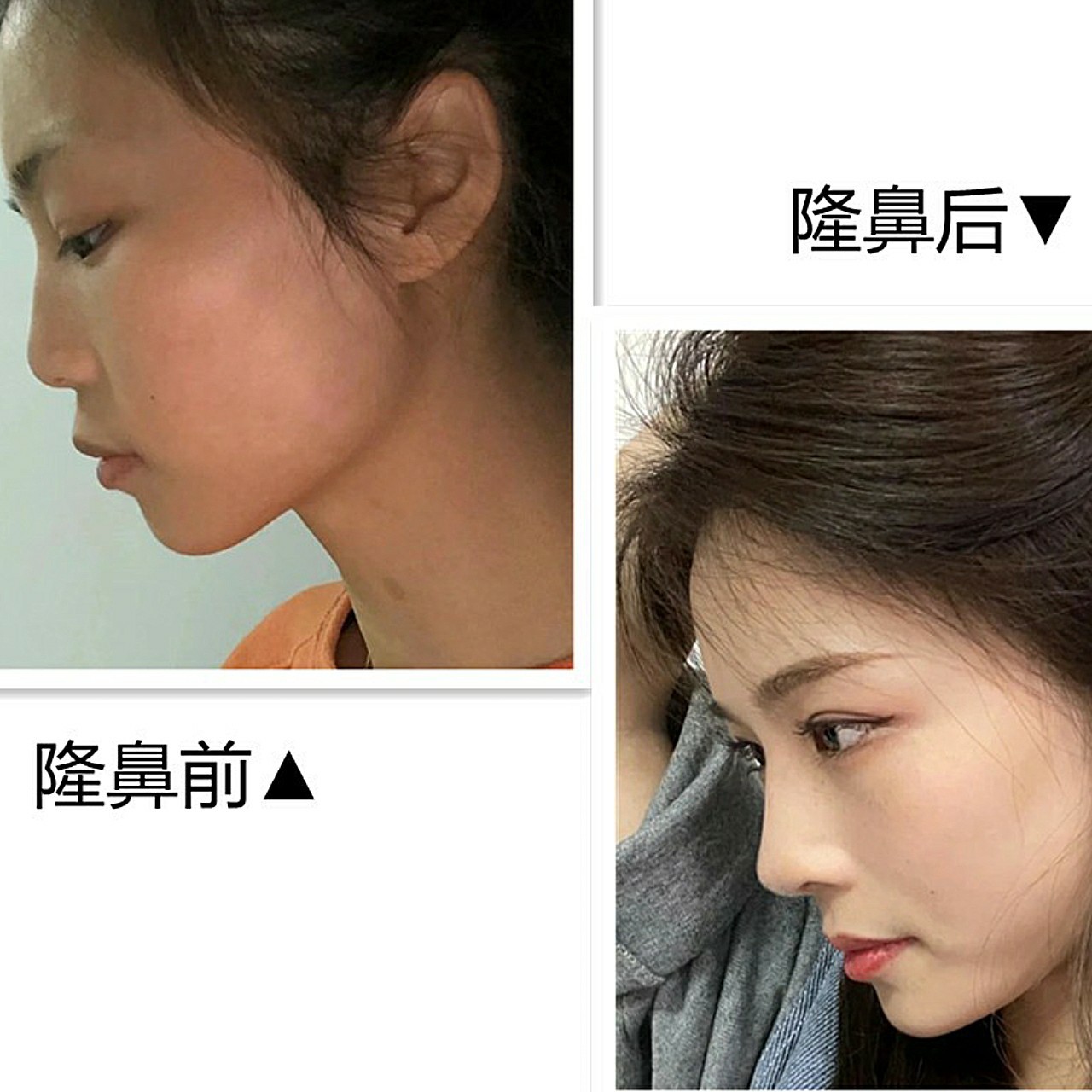 体验项目肋软骨隆鼻