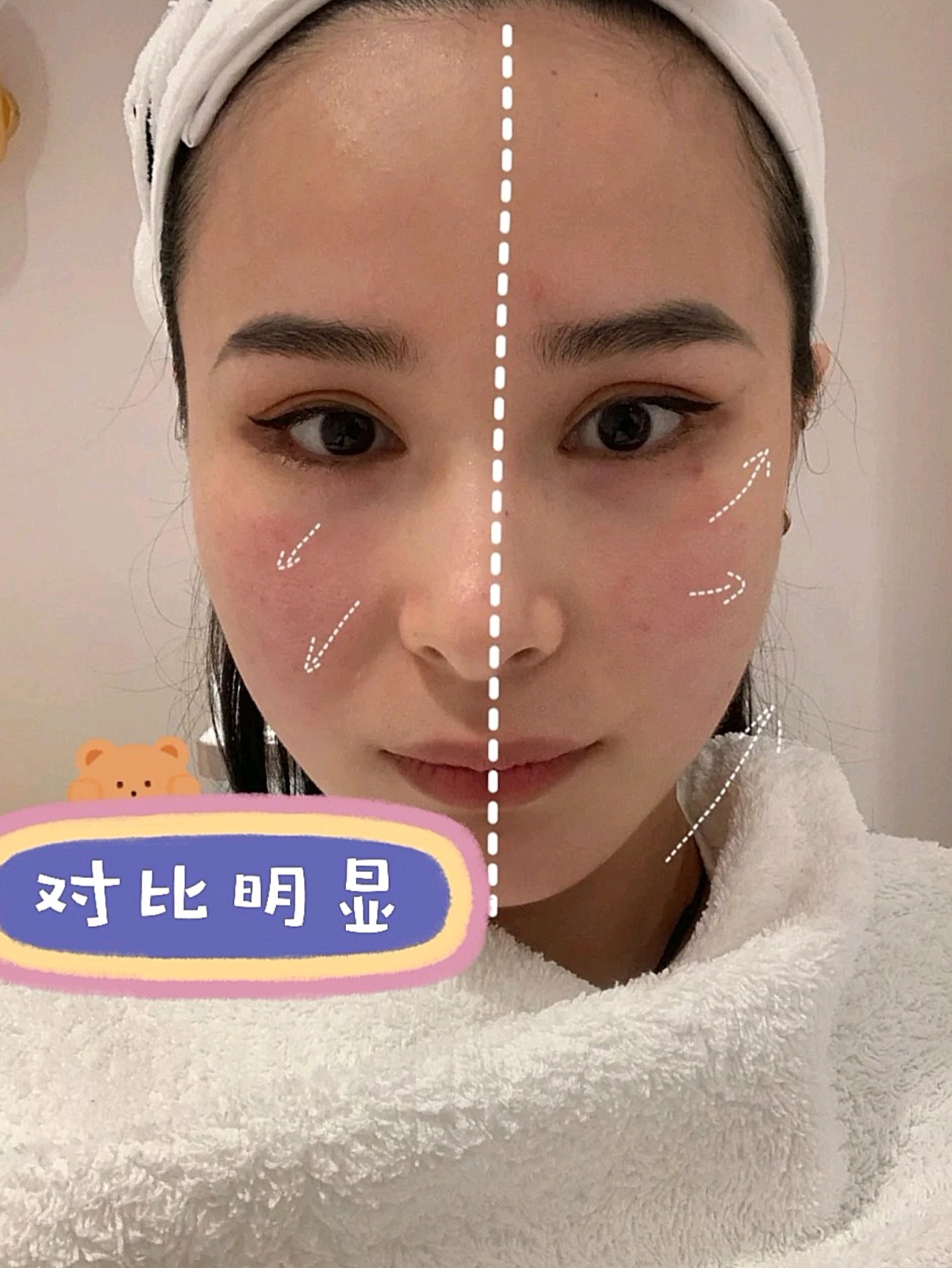 高清图片7d聚拉提效果图对比照7d抗衰面部对比照7d聚拉提的效果对比图