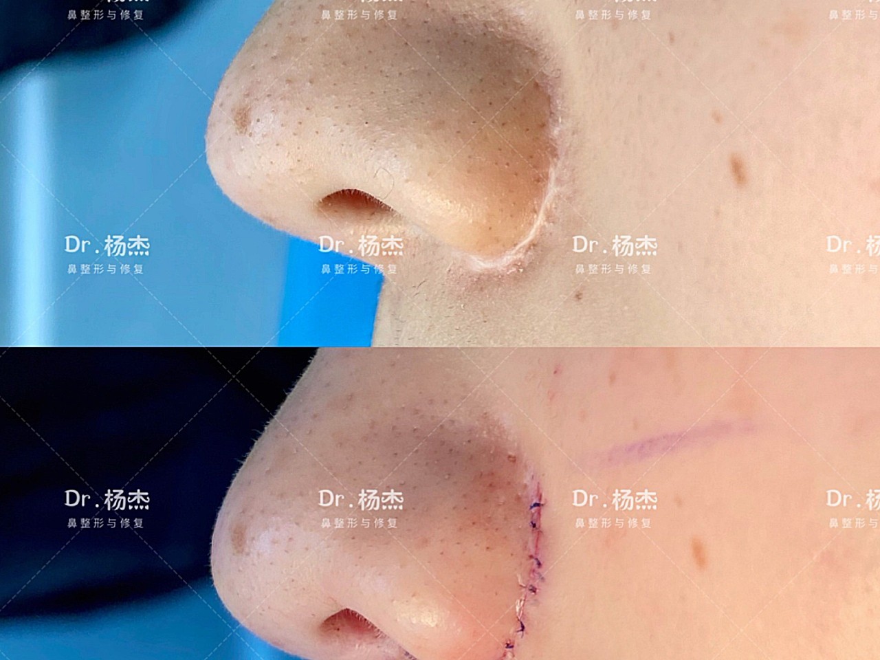 1,双侧鼻翼鼻面沟上下2mm宽的增生性疤痕,表面发白,并延伸至鼻孔; 2