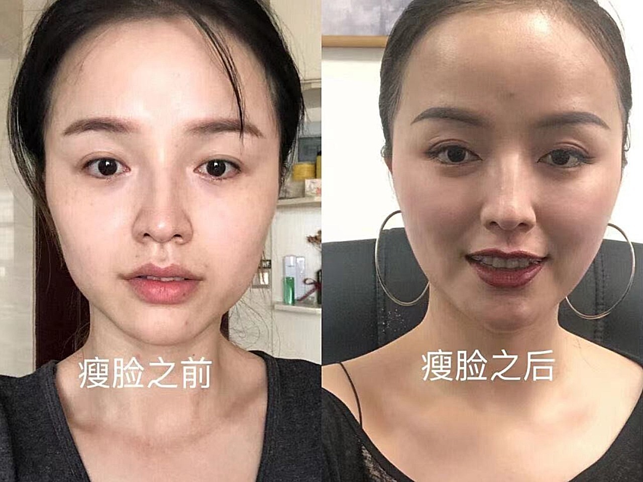 第一次打瘦脸,只单单打了瘦脸,没有做下颌线放松,导致脸颊凹陷,口角