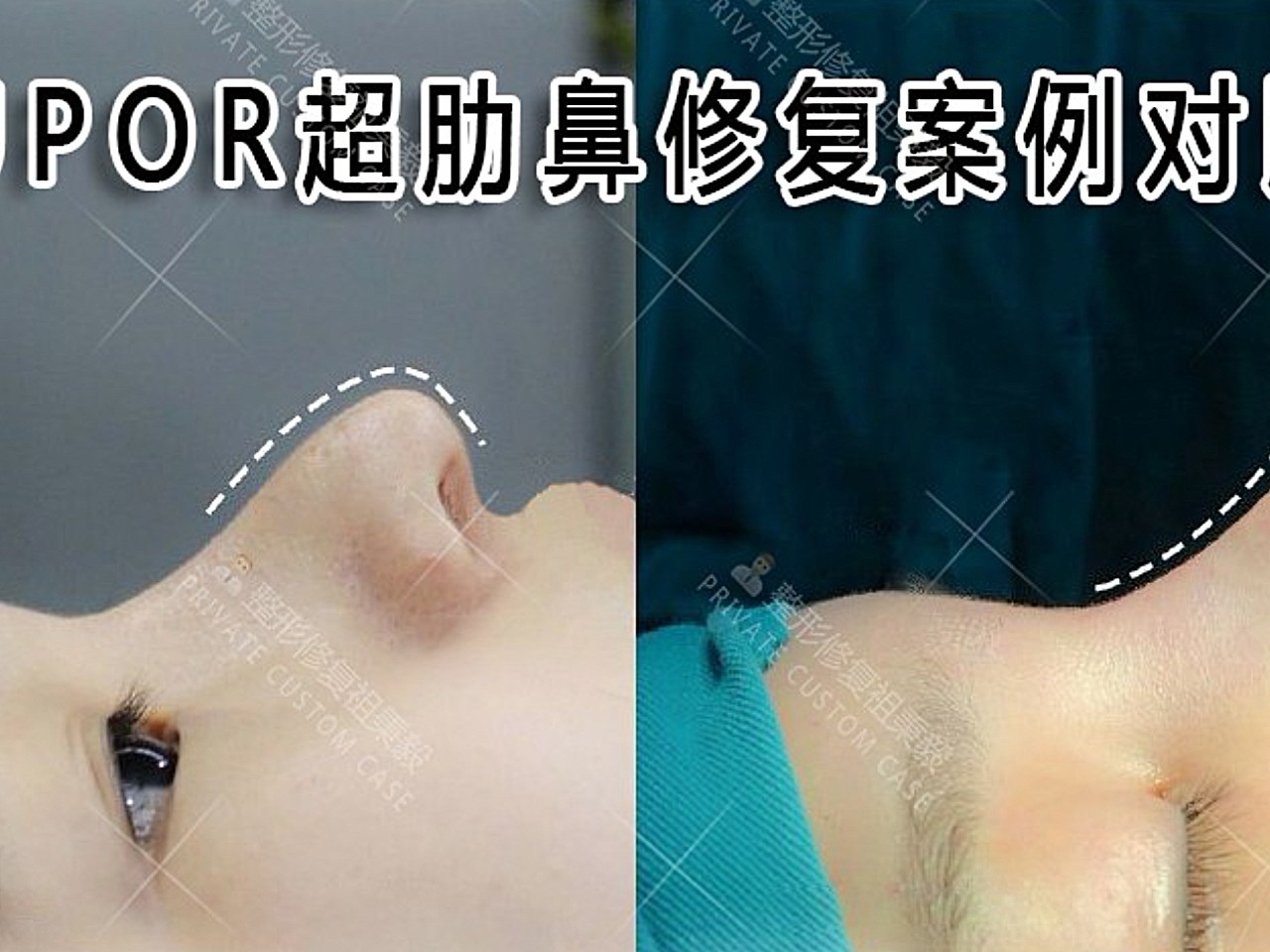 超肋隆鼻【supor超肋鼻修复】