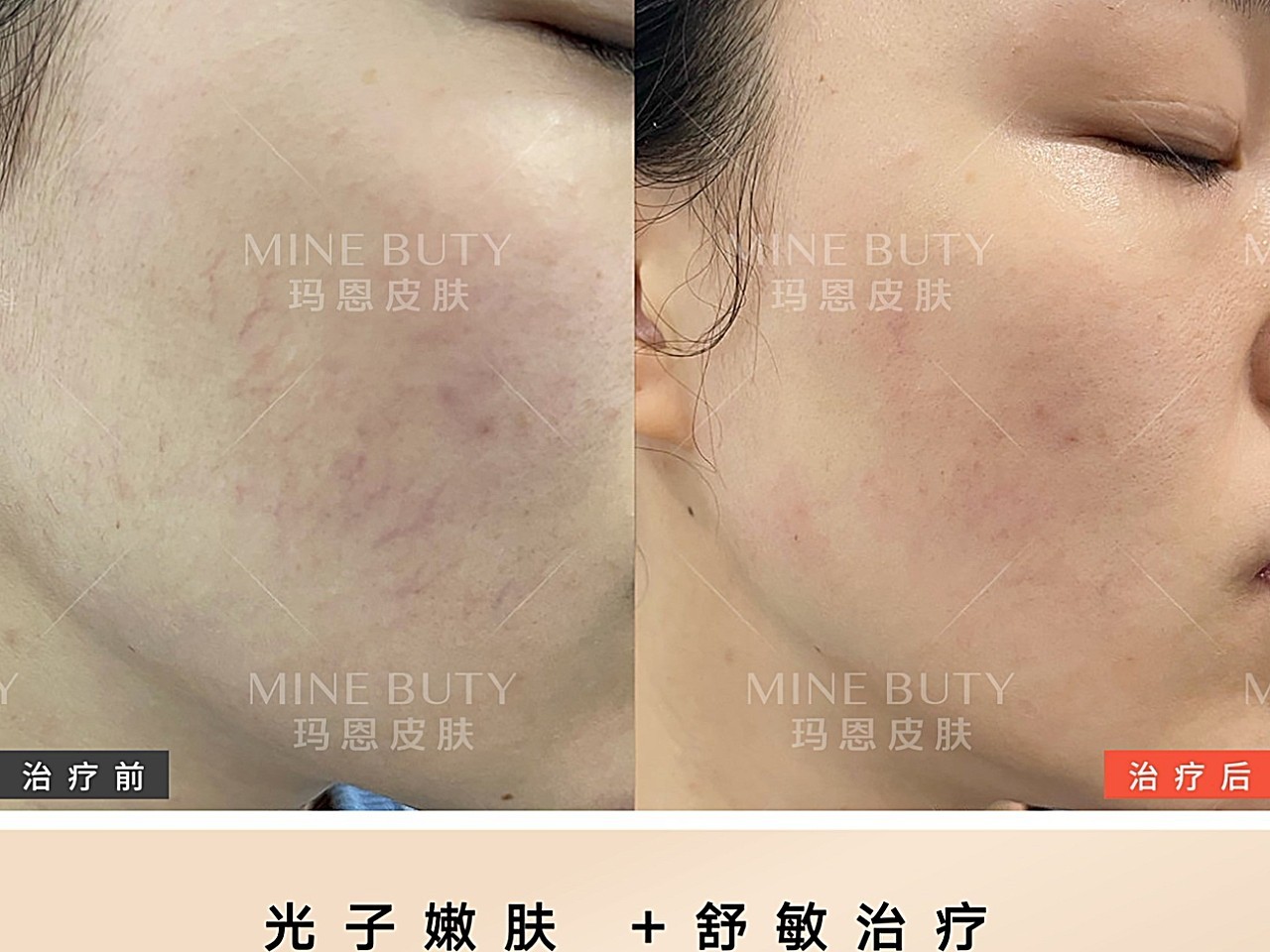 光子嫩肤后会变黑?不反黑秘诀看这里!