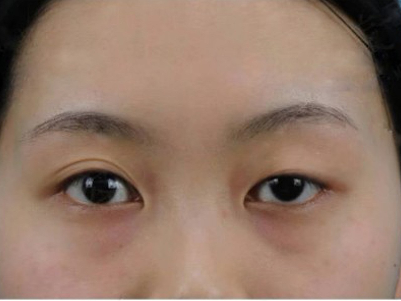 术前诊断左眼先天性上睑下垂,平素睁眼无力,需抬头皱
