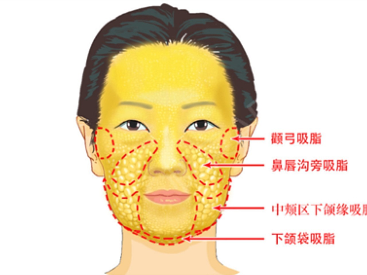 面部脂肪下垂怎么办?