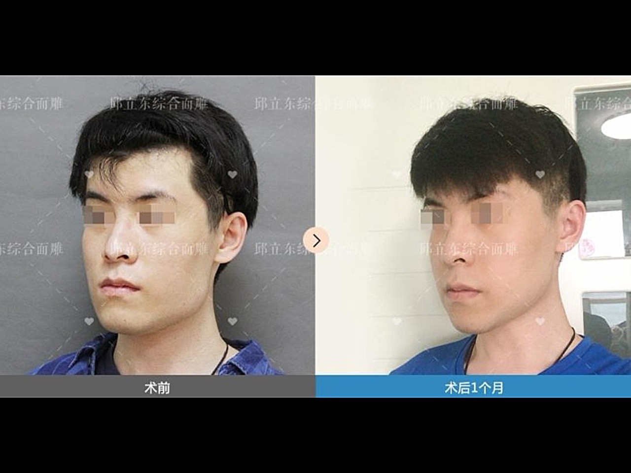 邱立东下颌成角截骨男孩术前下颌角方,宽且外翻,还