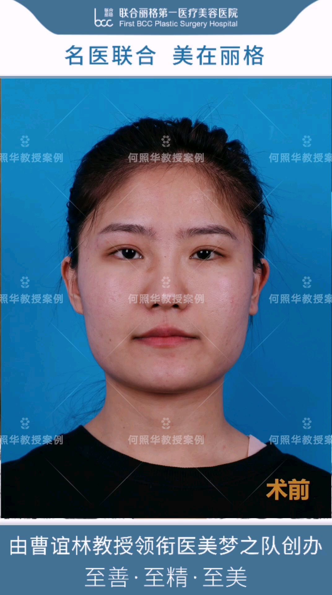 国字脸女孩的改脸型经历