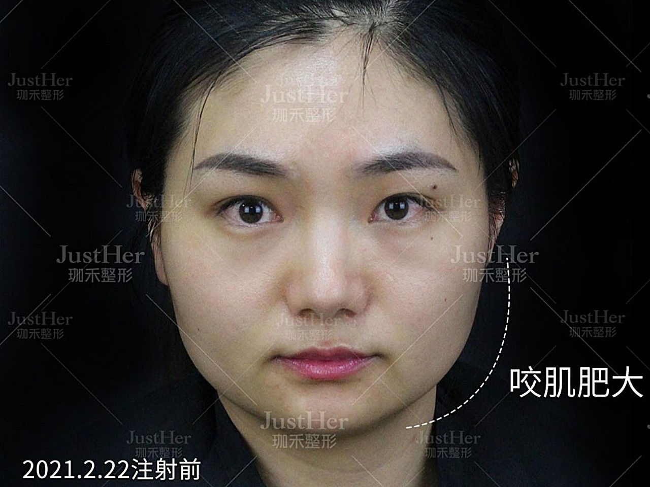 双侧咬肌肥大