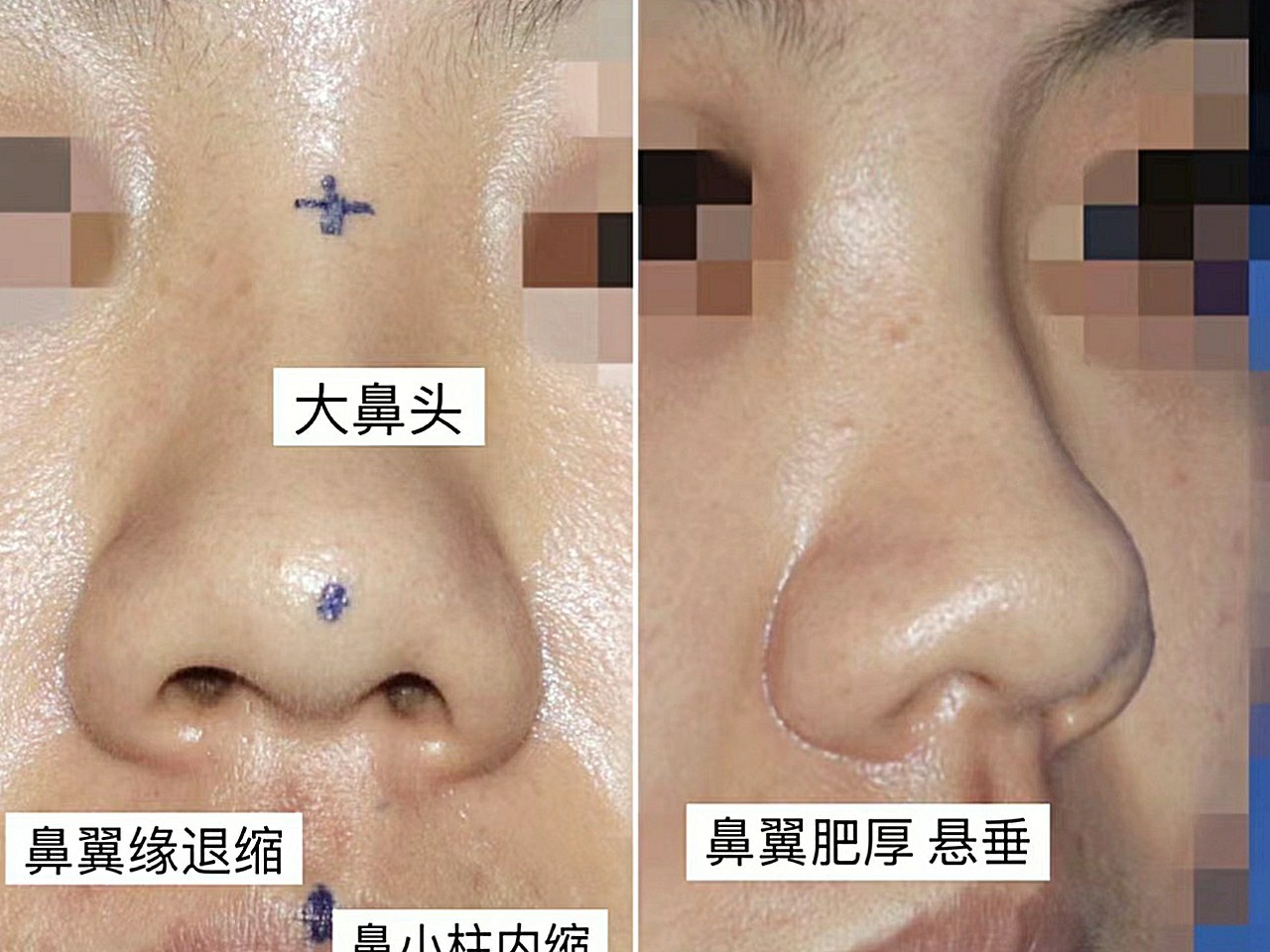 肥大短缩鼻,肥大和短缩是很多亚洲肥大鼻的主要特征.