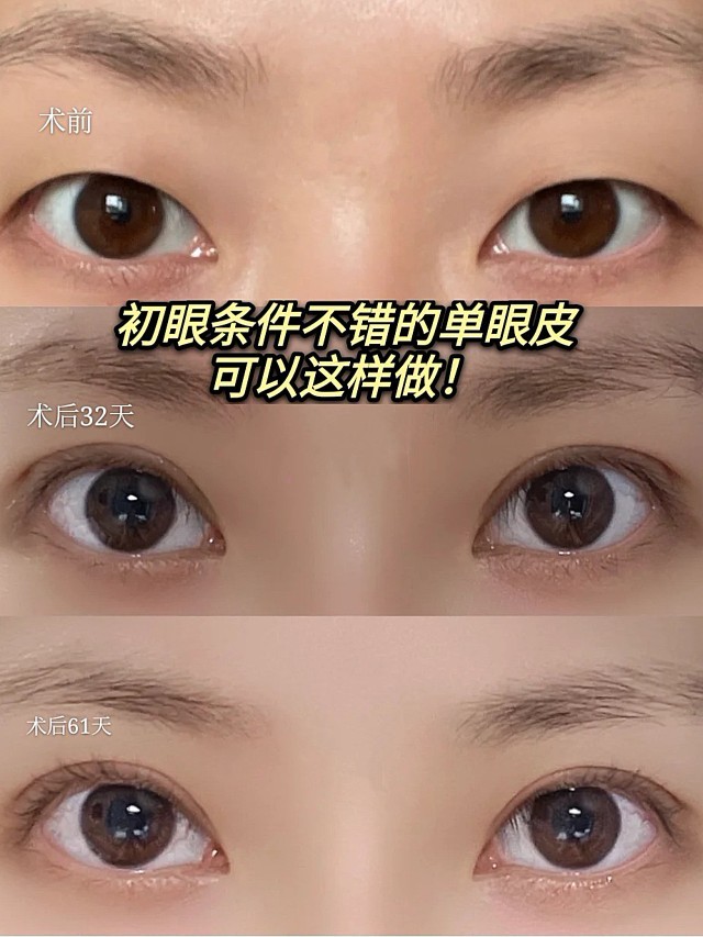 这位求美者的初眼基础是非常不错,眼距和眼裂长度适中,内眼角充分