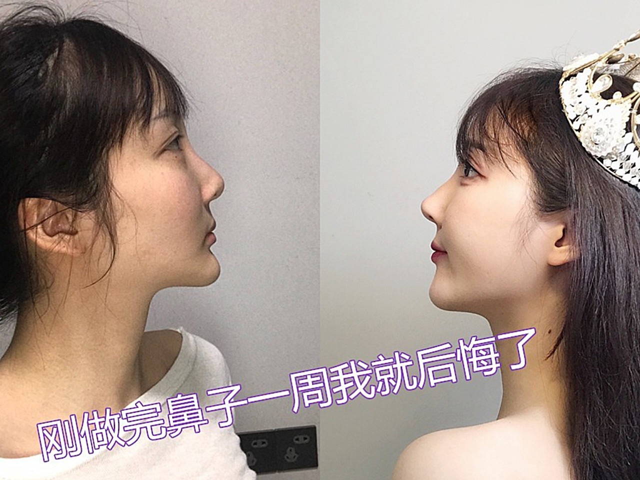 做完鼻子才一周,我就后悔了