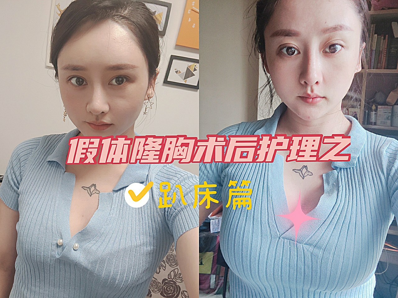 假体隆胸曼托