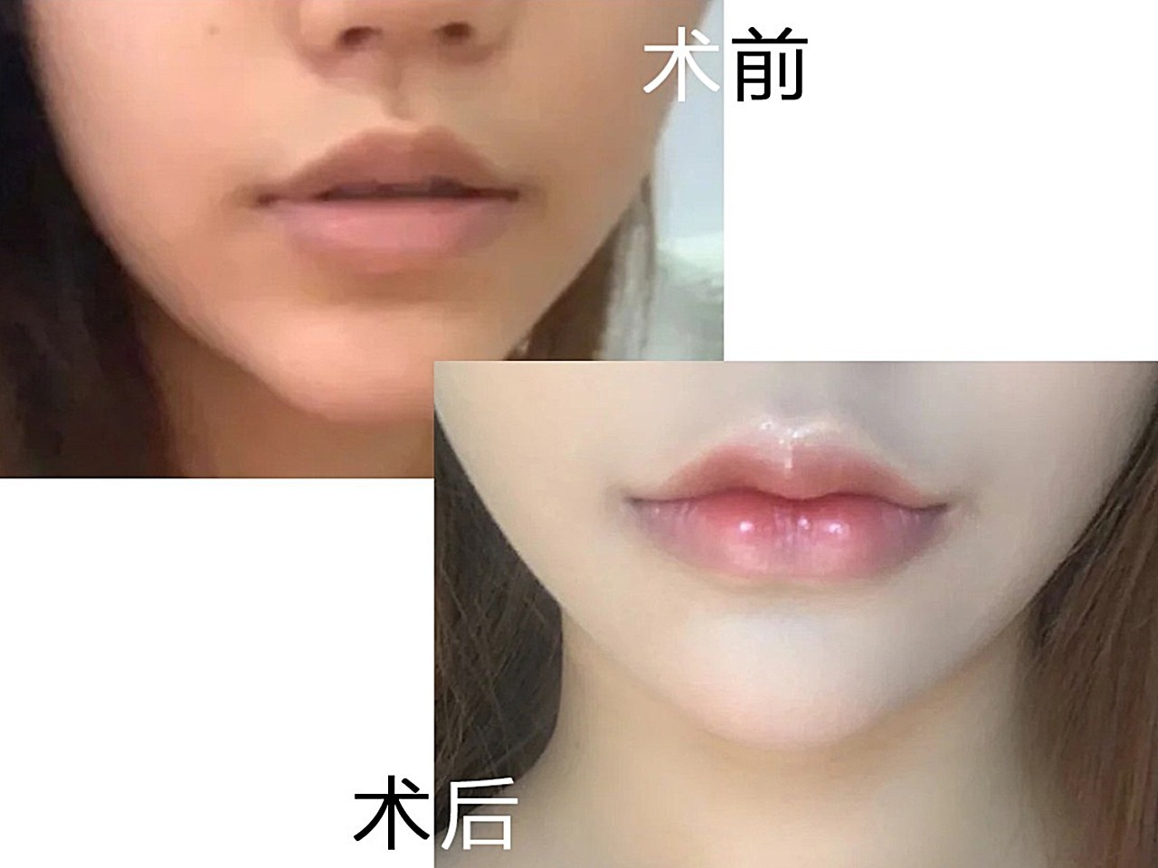 唇珠不明显,唇形不清晰