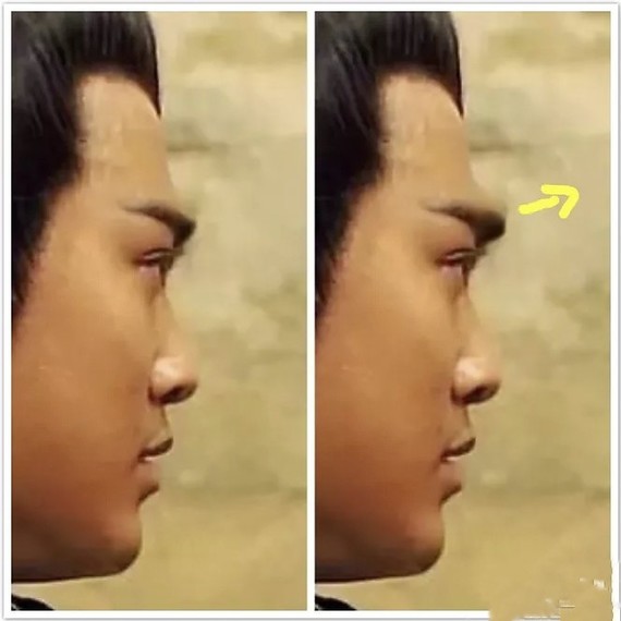 什么样的脸不能做高眉弓