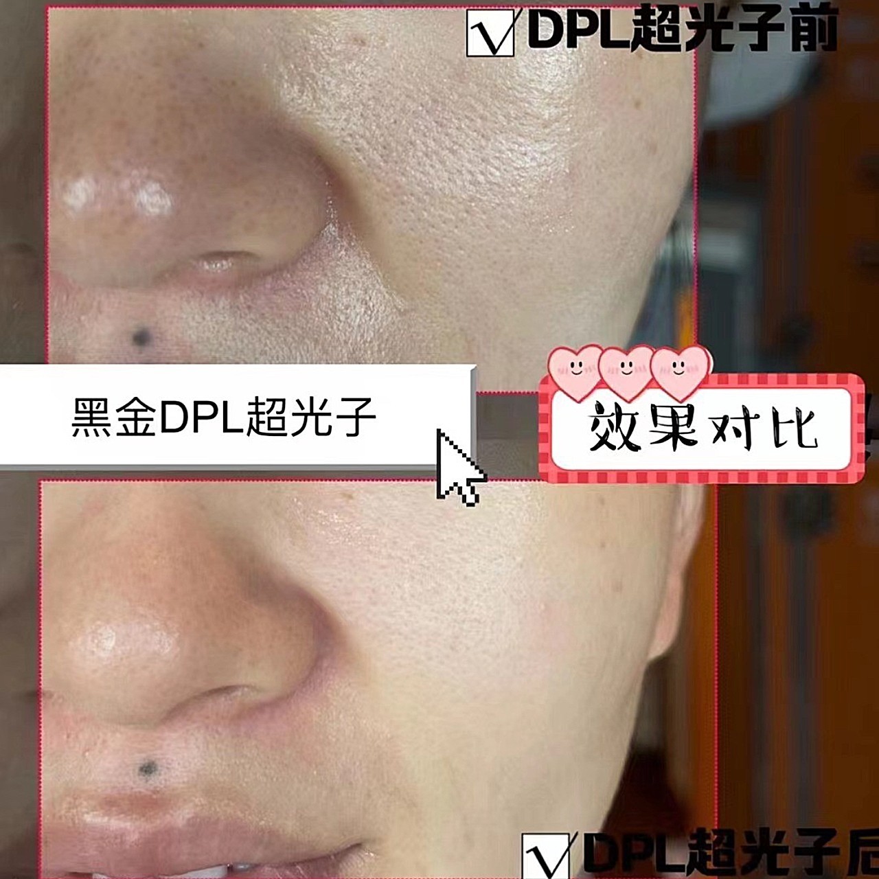 黑金超光子和普通光子嫩肤的区别?