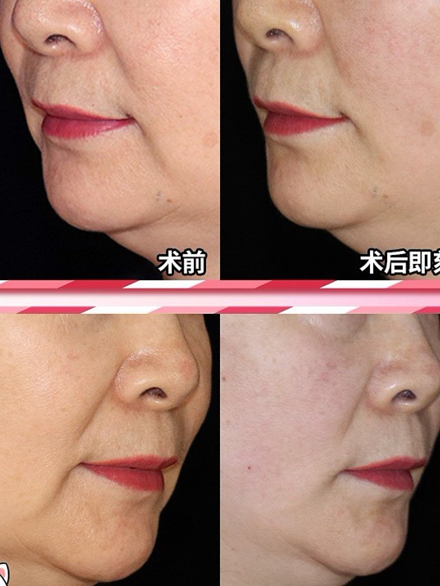口角囊袋怎么去除?