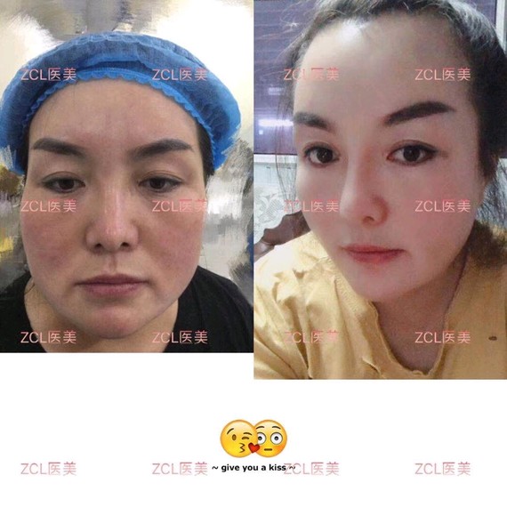 鼻综合+面部吸脂塑形术后3个月适应症:山根凹陷，鼻梁低，鼻头短，轻微朝天_圈子-新氧美容整形