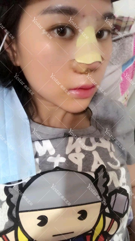 『重庆艺星-金辉院长』隆鼻哪种方式好?面部一