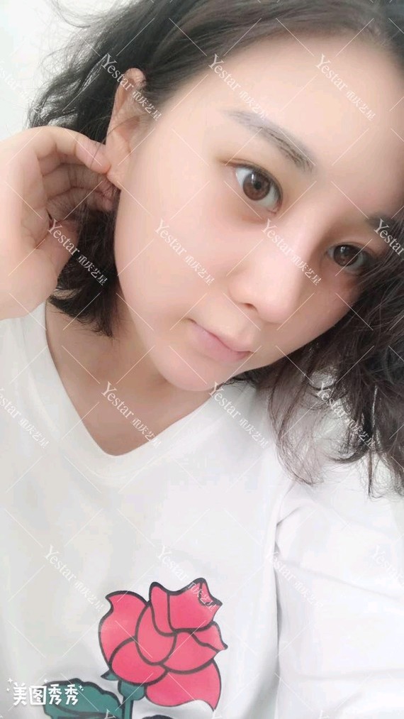 『重庆艺星-金辉院长』隆鼻哪种方式好?面部一