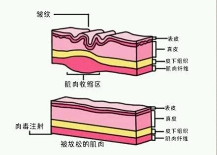 【福州美贝尔】注射肉毒素除皱针两天后见效肉