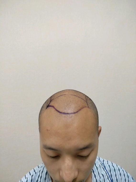 #男士发际线+头顶种植#又是一台大面积种植手