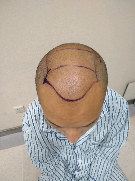 #男士发际线+头顶种植#又是一台大面积种植手