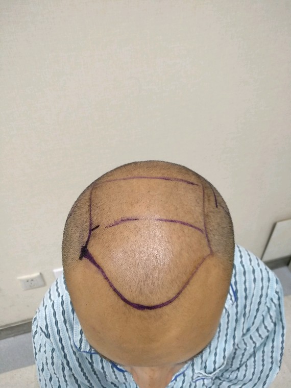 #男士发际线+头顶种植#又是一台大面积种植手