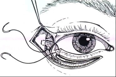 外眦成形术矫正下睑退缩 !