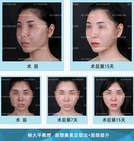 【面部提升手术切口的奥秘】爱美的女性将容貌视作生命,她们期望面部