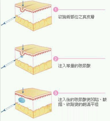 但是在注射玻尿酸之前大家需要了解一下有关玻尿酸注射去泪沟的相关