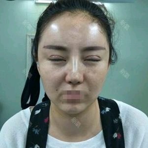 【上海李月辉】双眼皮间断埋线法怎么样?高分