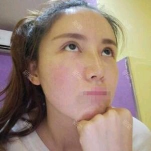 【上海李月辉】双眼皮间断埋线法怎么样?高分