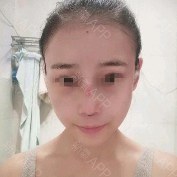 【上海李月辉-刘伟峰】1、鼻综合整形是怎么回