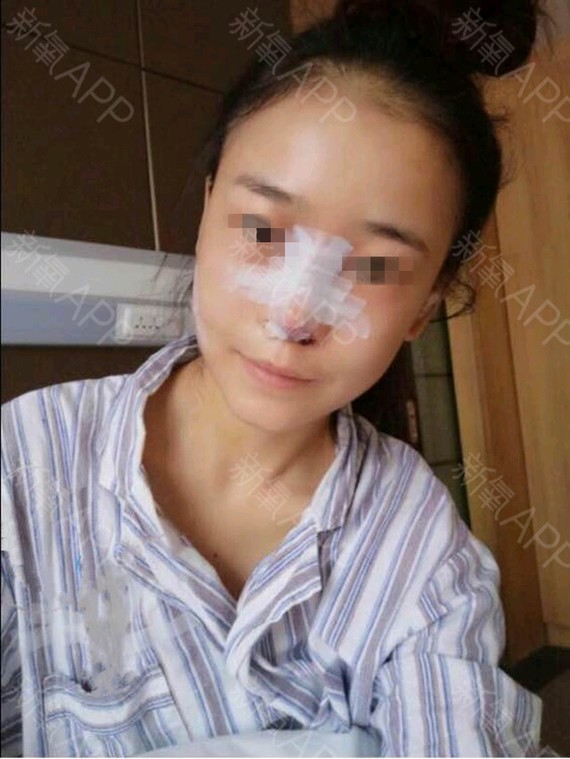 【上海李月辉-刘伟峰】1、鼻综合整形是怎么回