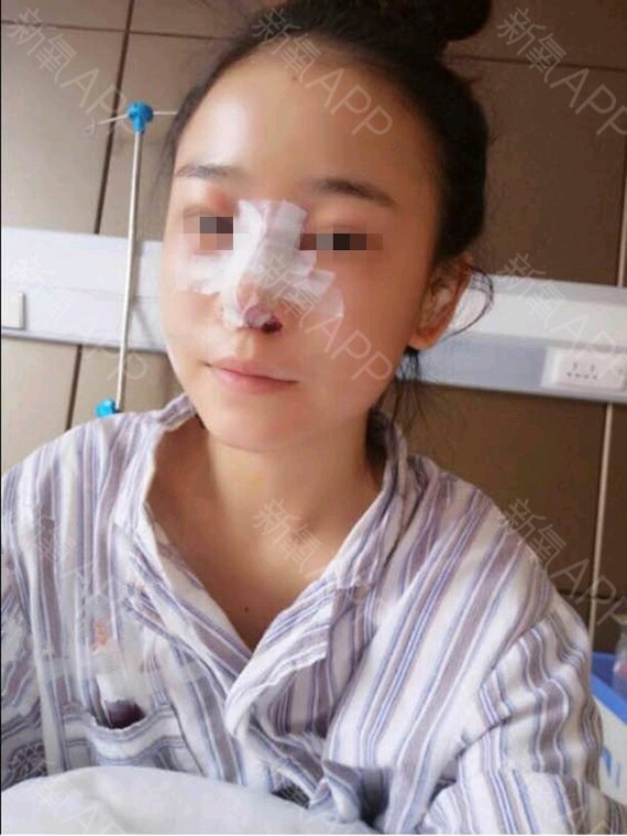 【上海李月辉-刘伟峰】鼻综合手术后,鼻孔有可