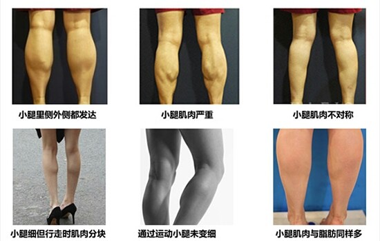【福州美贝尔】肌肉型小腿瘦腿针效果明显所称