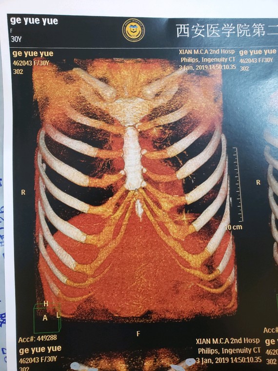 总结一下就是如果存在先天鼻畸形,不能接受人工组织建议做全肋,其余