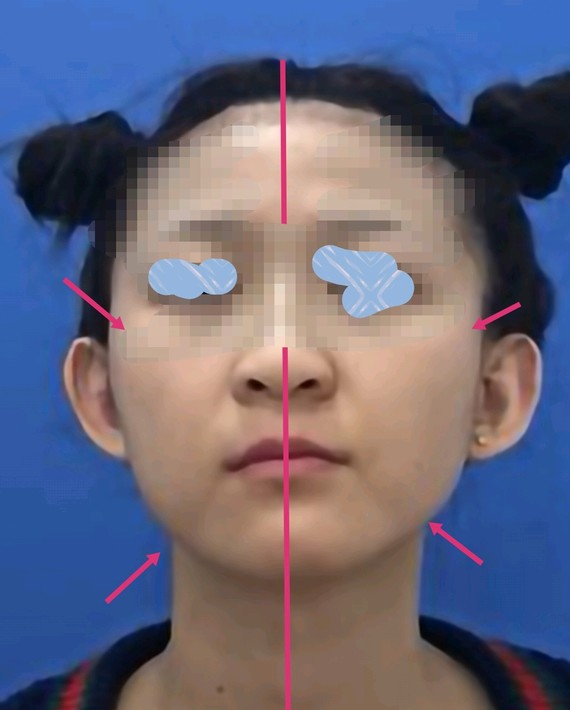 偏颌畸形往往是先天或后天发育畸形导致左右脸不对主要表现两边颧骨