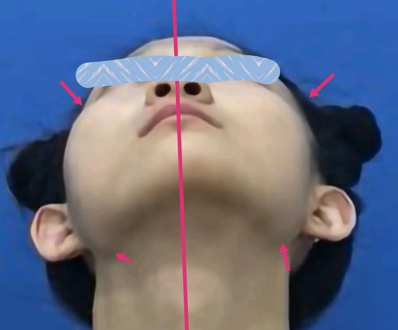 偏颌畸形往往是先天或后天发育畸形导致左右脸不对主要_圈子-新氧美容