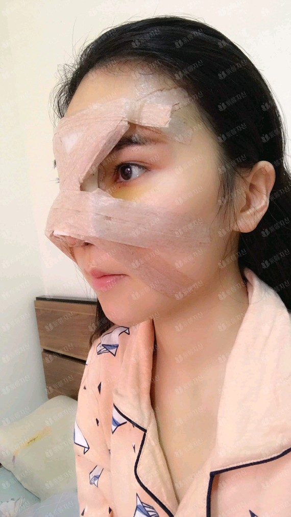 鼻综合术后要带着鼻夹,它的作用主要有以下几