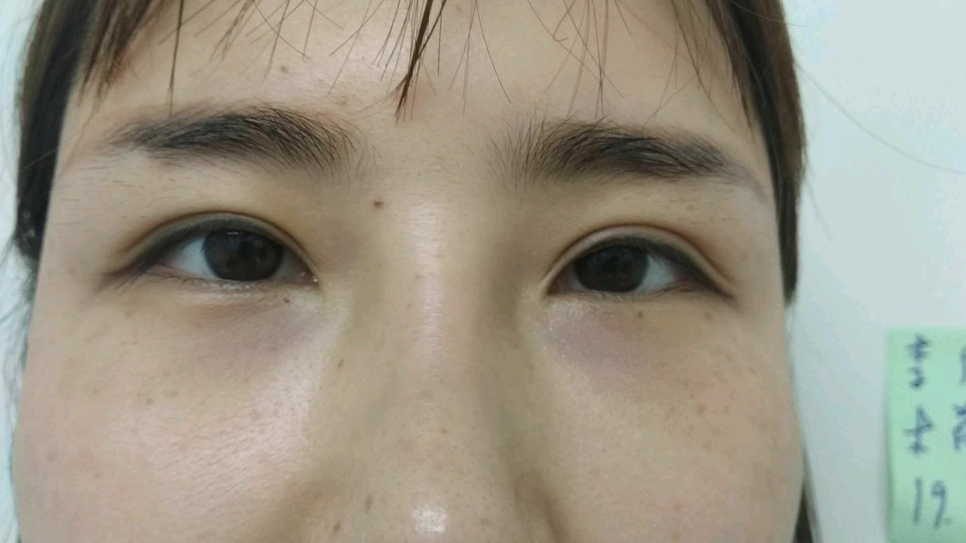 【下眼下至术】眼睑下至口碑医院 灵动无辜眼 get精灵