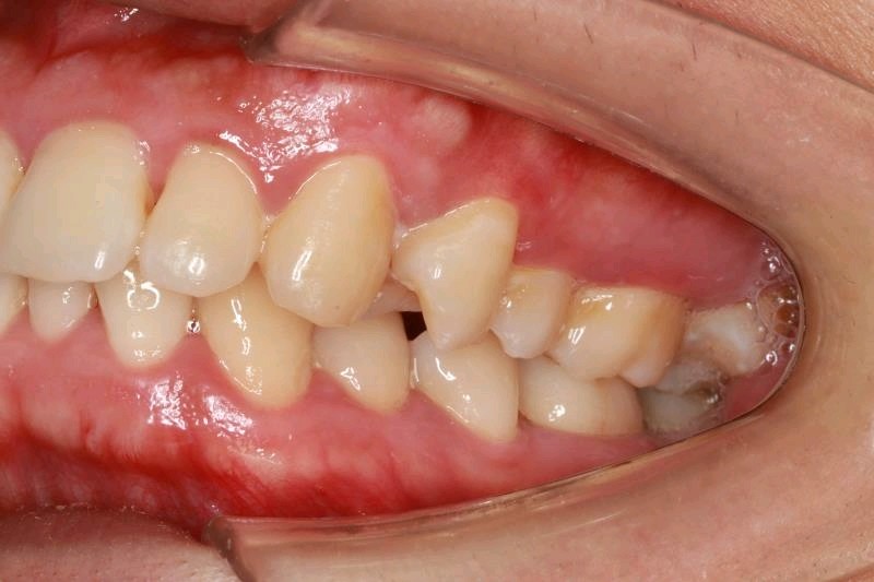 【拔智齿】微创拔牙 创伤小 愈合快 牙齿治疗/拔上牙智齿(正位)口腔