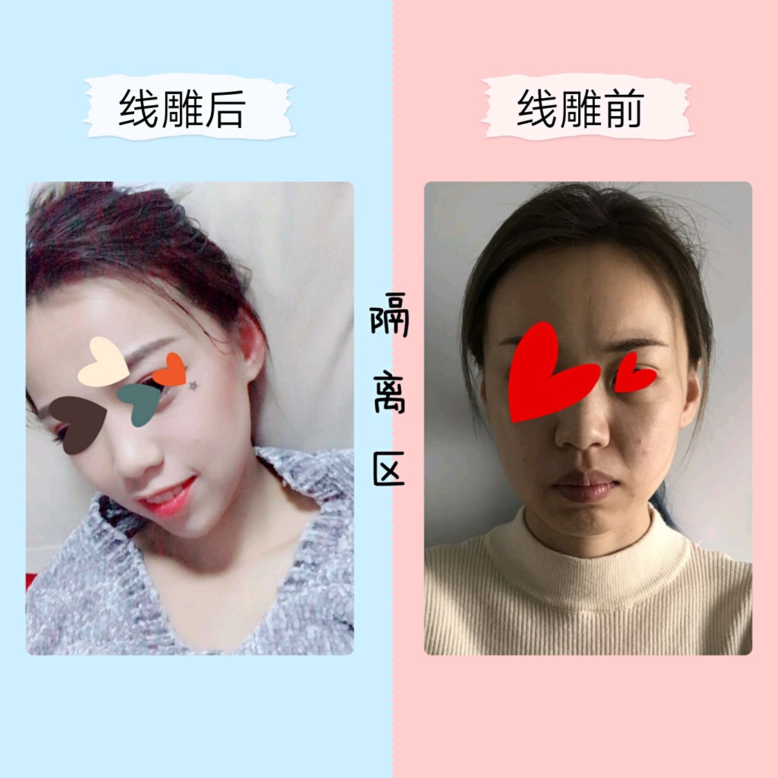 【埋线提升】速v瘦脸线|线雕瘦脸大v线提升轮廓提升重塑下颌缘逆龄