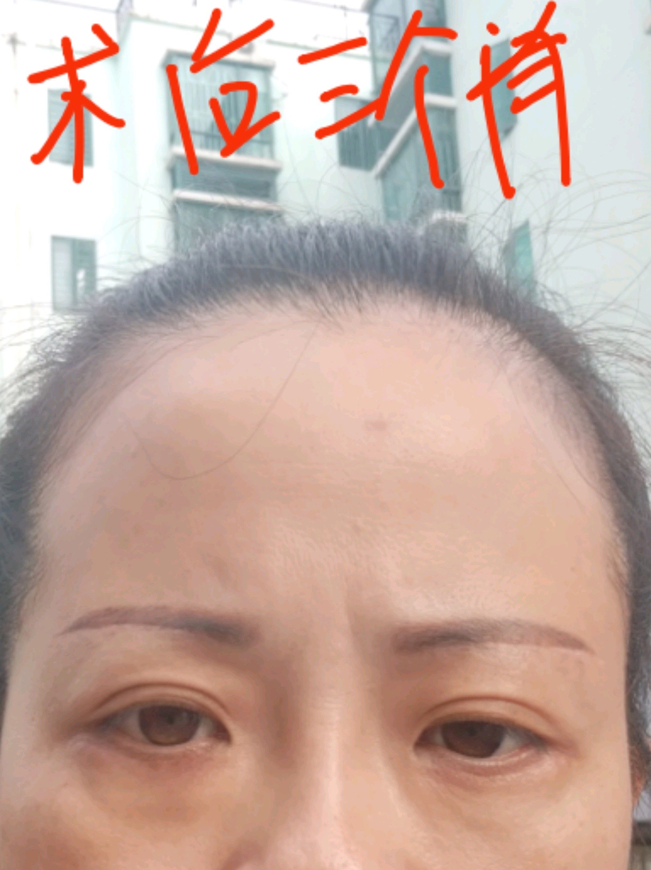我是提眉和外切眼袋一起做的,现在做完已经三个月了.