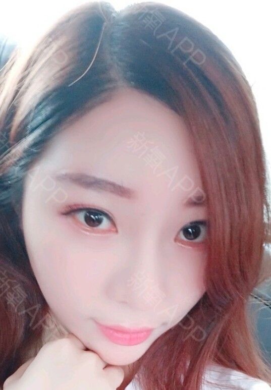 种发际线后效果真的是惊人的,妥妥的对比,以前那大脸门衬很脸