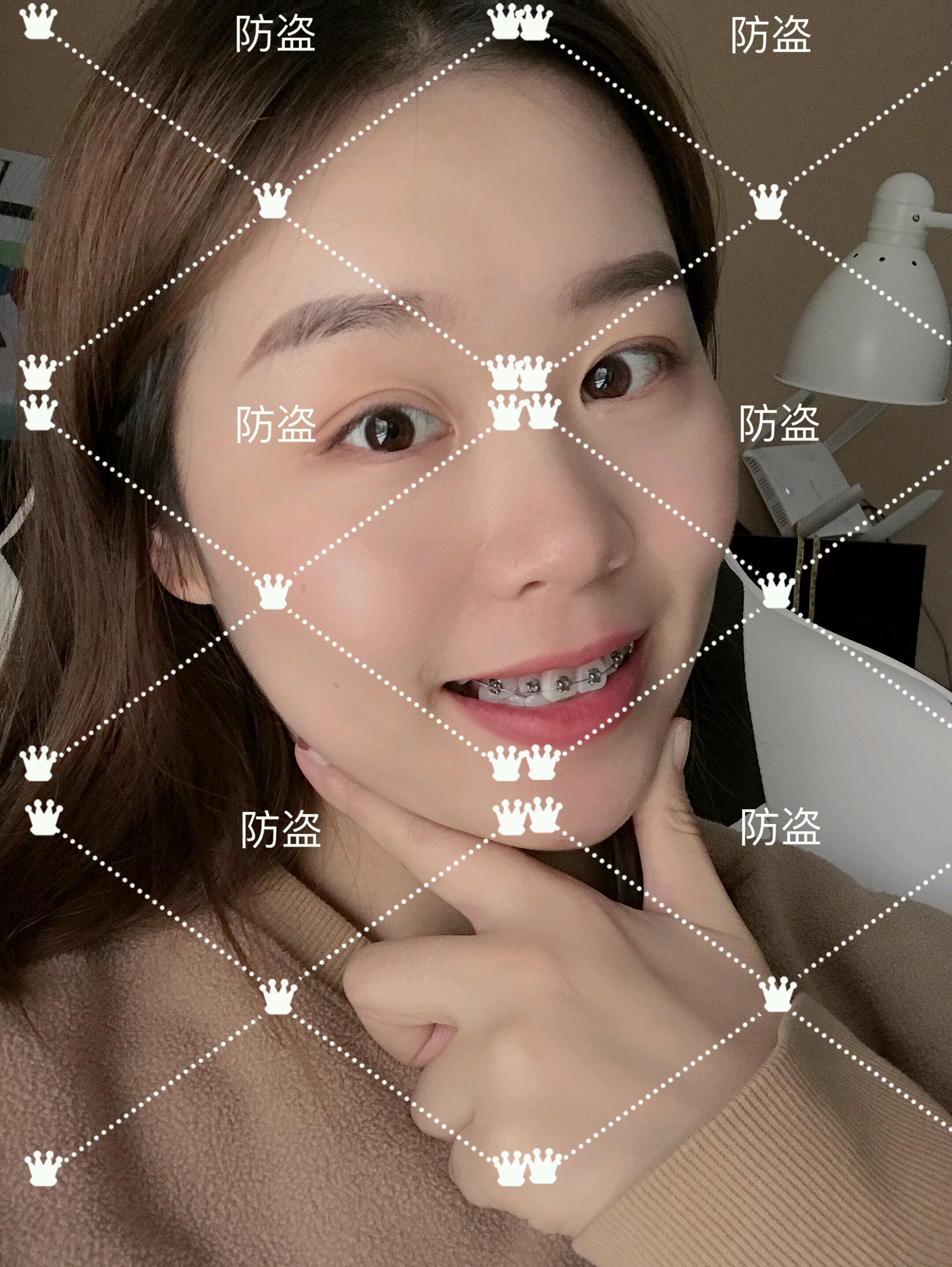 【金属托槽矫正】成都热销牙齿矫正龅牙箍牙/矫正深覆合/牙套纠正