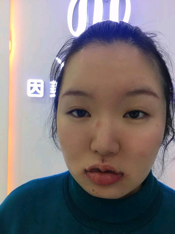 【m唇手术】因美 丘比特m唇/甜美 软萌