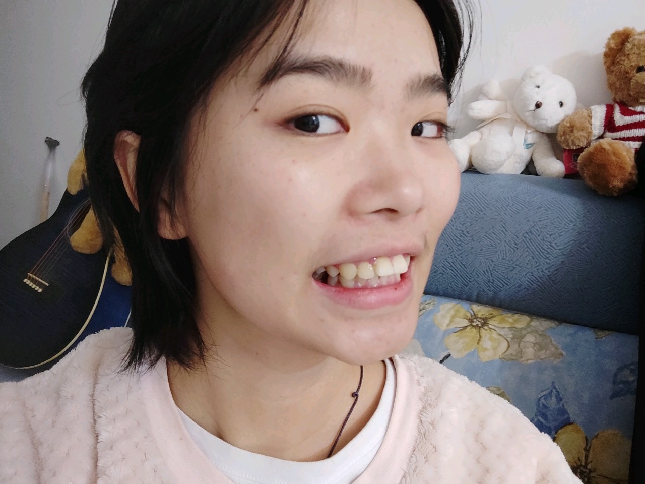 牙齿问题主要是上排牙齿前突,作为学生经济能力有限,_圈子-新氧美容